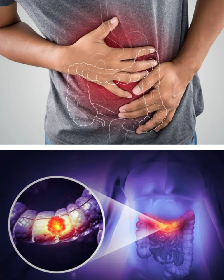 Cancerul colorectal