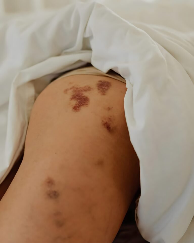 Lepră confirmată în România. Ce simptome apar și cum se transmite